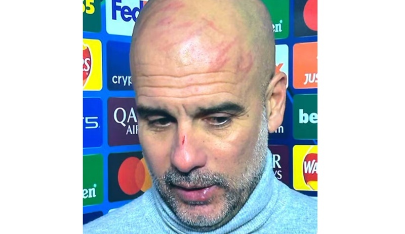 Tenso Rapper Manchester Guardiola revela marcas no rosto após empate tenso do Manchester City